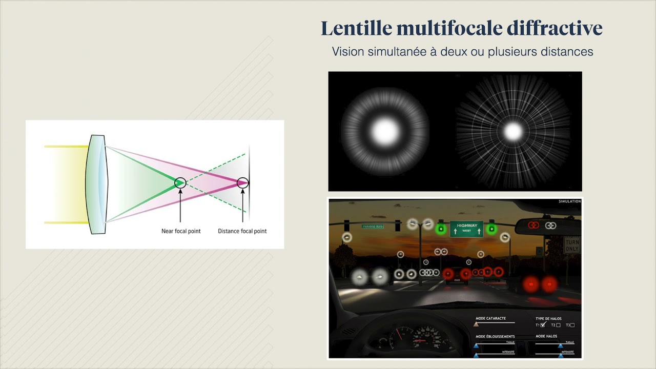 Lentilles intraoculaires multifocales