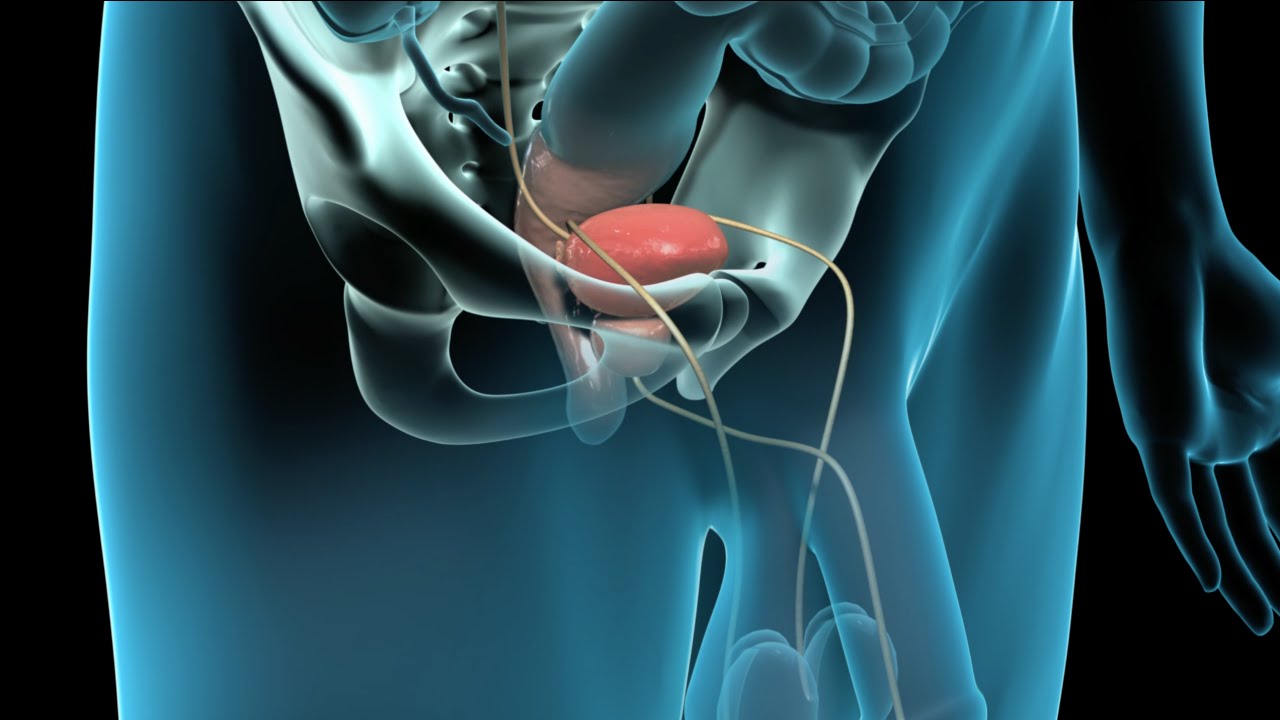 Prostatectomía radical