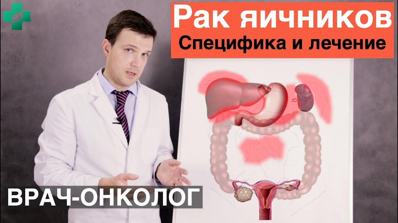 Рак яичников. Специфика и лечение рака яичников