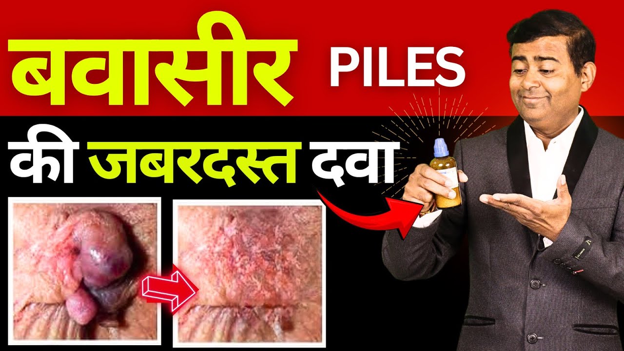 पाइल्स की सबसे अच्छी दवा l piles treatment #piles