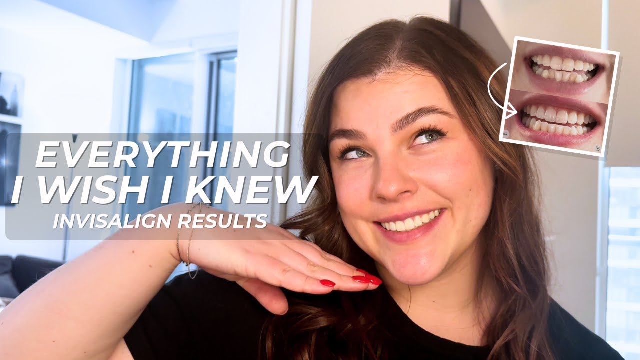INVISALIGN RESULTS (Before & After) | Everything I Wish I Knew + Costs, Pain & Attachments
