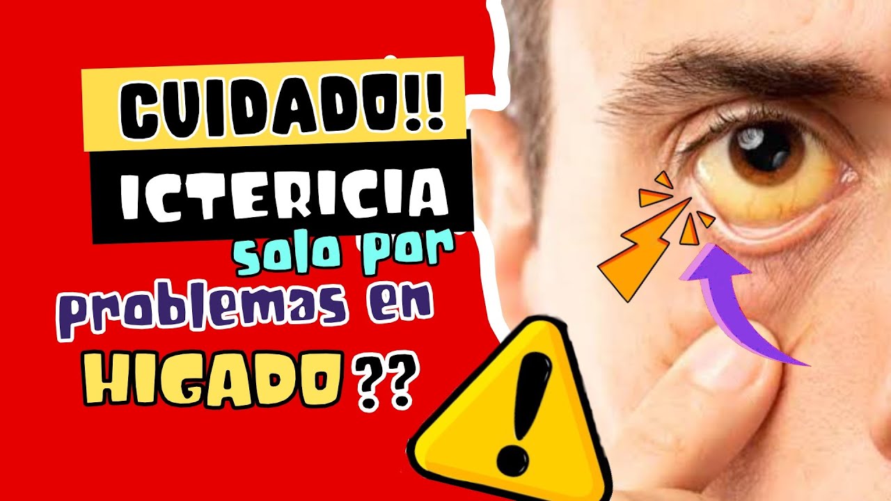 COLOR AMARILLO EN PIEL? CUIDADO !! ¿QUÉ ES LA ICTERICIA ?