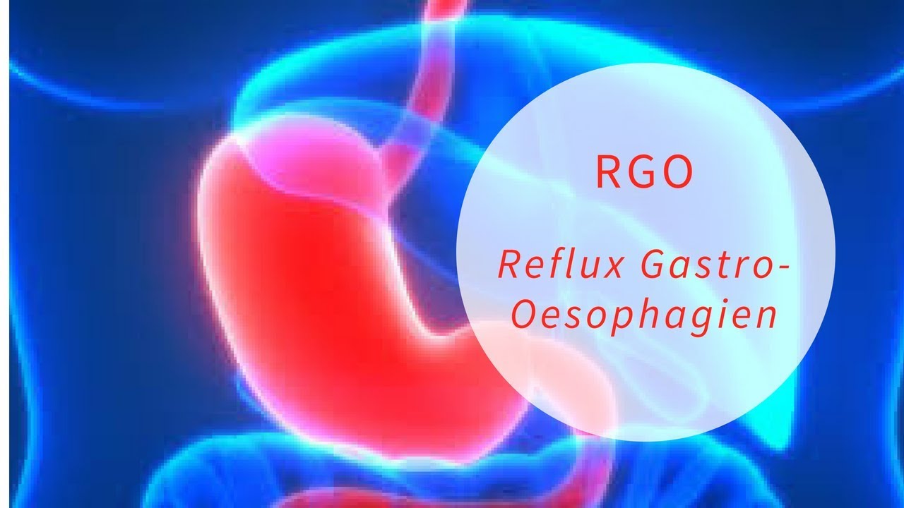 Reflux gastro-œsophagien (R.G.O) إرتجاع المريئ الأعراض والوقاية