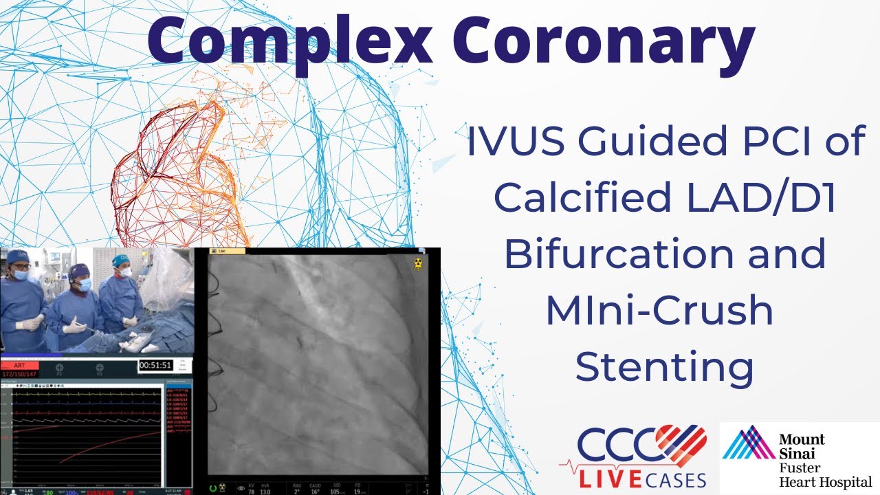 IVUS Guided PCI of Calcified LAD/D1 Bifurcation and Mini-Crush Stenting