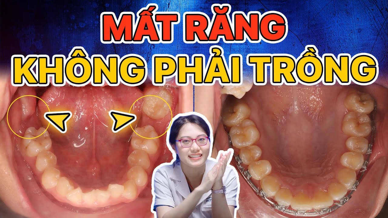 Mất Răng 6, 7 Không Cần Trồng Lại Vẫn Đều Đẹp - Giải Pháp Là Gì? Tung Chứng Cứ Rõ Ràng!