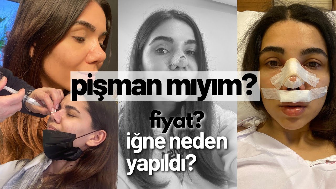 KALIN DERİLİ BURUN ESTETİĞİ AMELİYATI SÜREÇ | Pişman Mıyım? FİYAT ? KÖTÜ YORUMLAR |