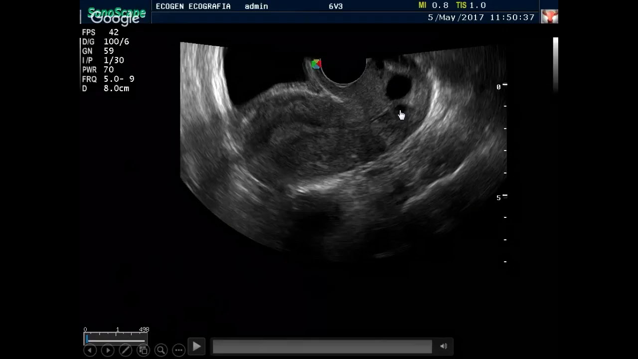 7º Módulo (Ginecologia y obstetrícia): Imagenologia Ginecologica