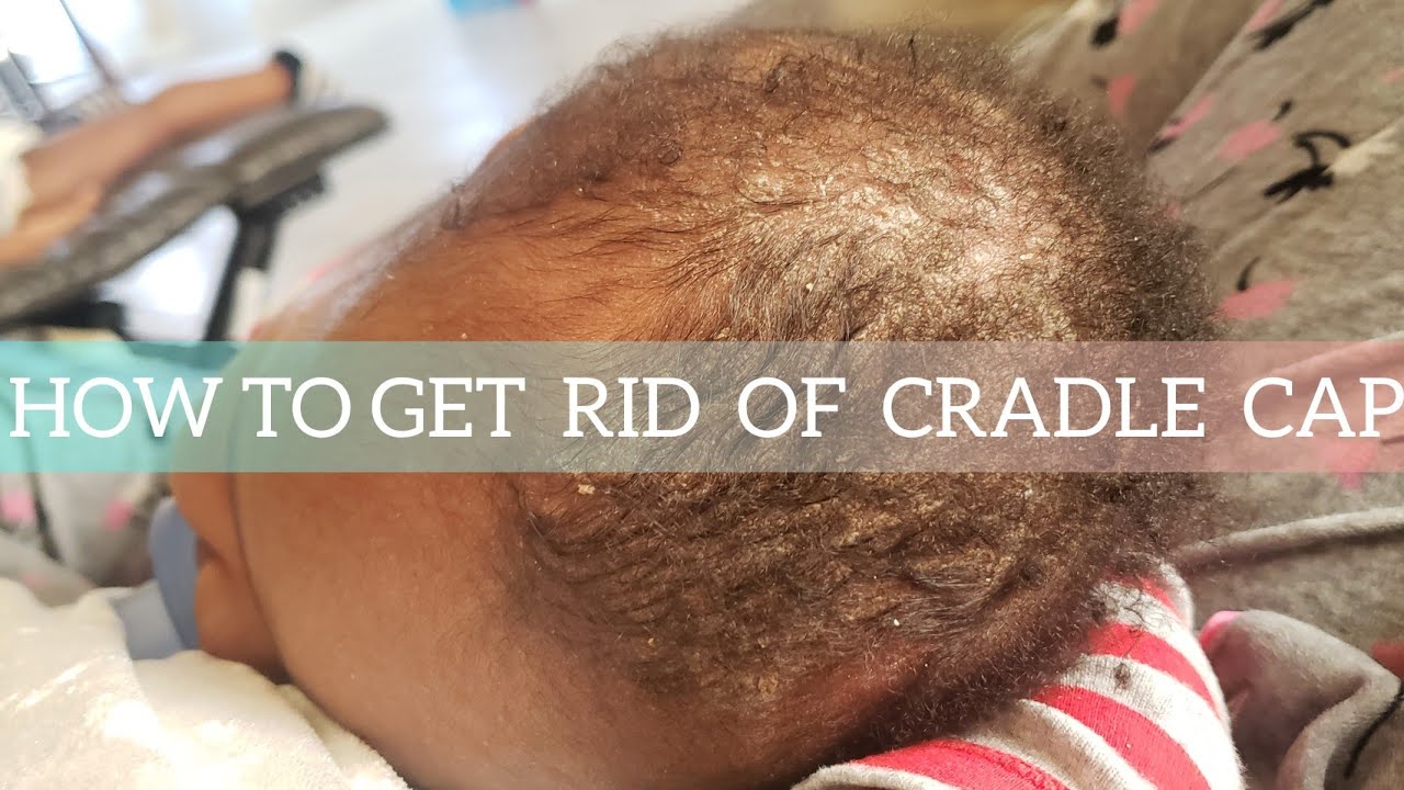 HOW TO GET RID OF CRADLE CAP? | STEP BY STEP TUTORIAL
