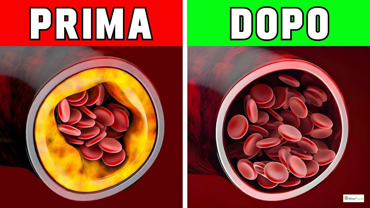 Cosa Mangiare Per Pulire Le Tue Arterie / Ossisteroli / Colesterolo Ossidato