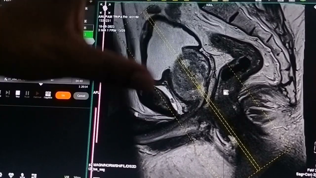 MRI PROSTATE SCANNING INTERPRETATION
