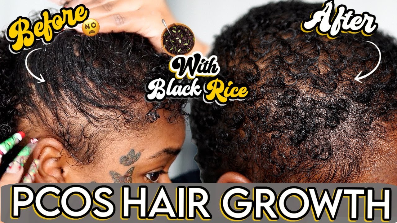PCOS HAIR GROWTH JOURNEY | ❌ NO MORE 🚫 DRY SCALP OR BALDING | BLACK RICE OIL | Laurasia Andrea PCOS