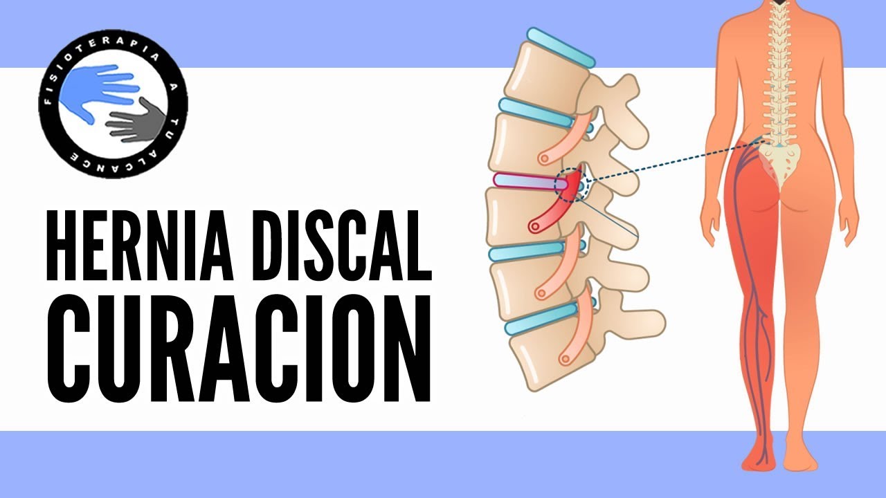 Las hernias de disco se curan con el tiempo