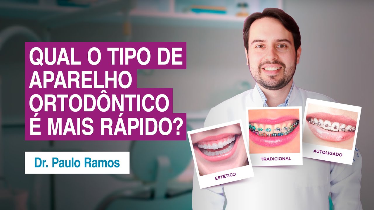 Qual Tipo de Aparelho Ortodôntico é mais rápido?