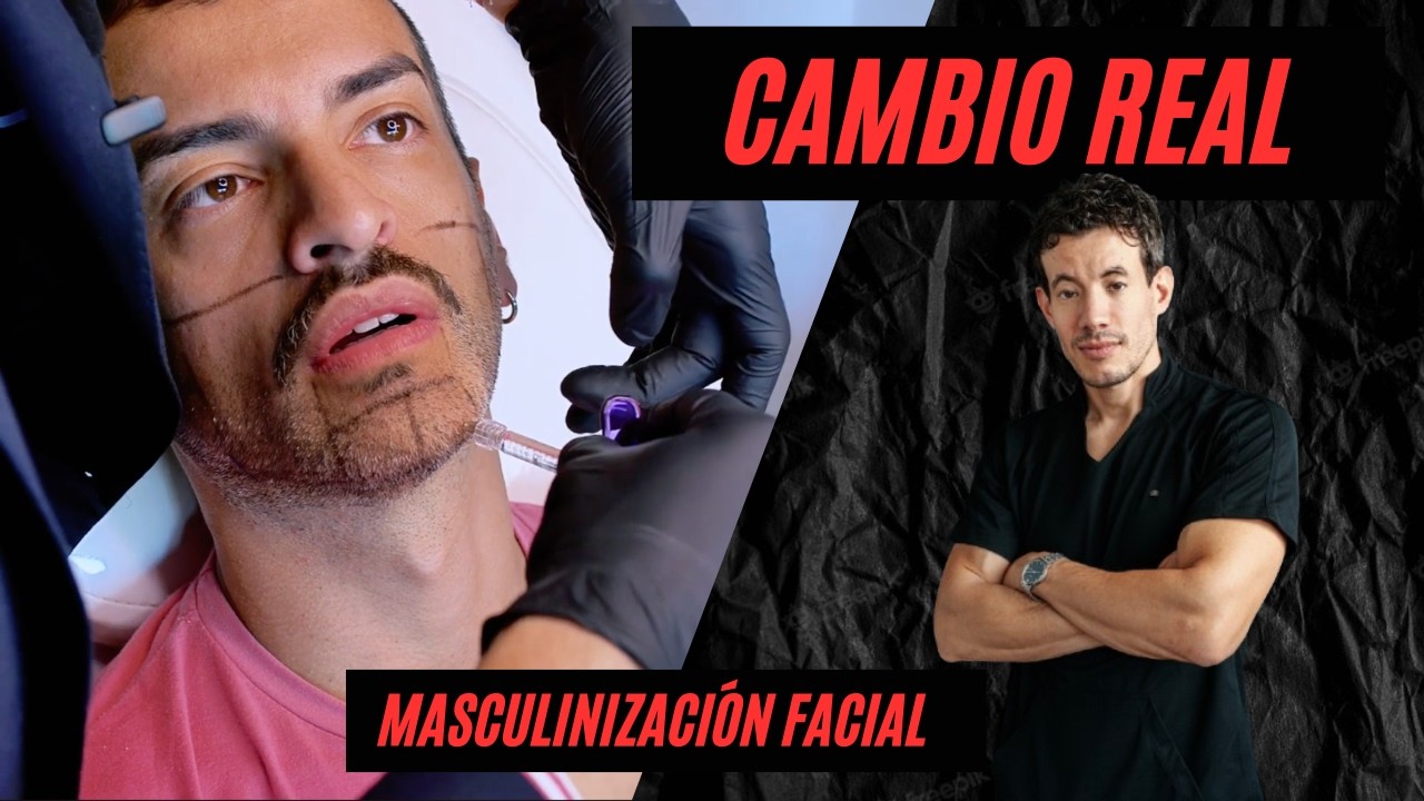 MASCULINIZACIÓN FACIAL One to One | Dr Franco Moreschi, Docente Tech University | MASTER INJECTOR