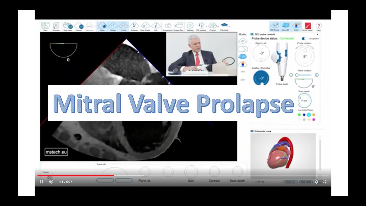 TEE simulator - Mitral Valve Prolapse