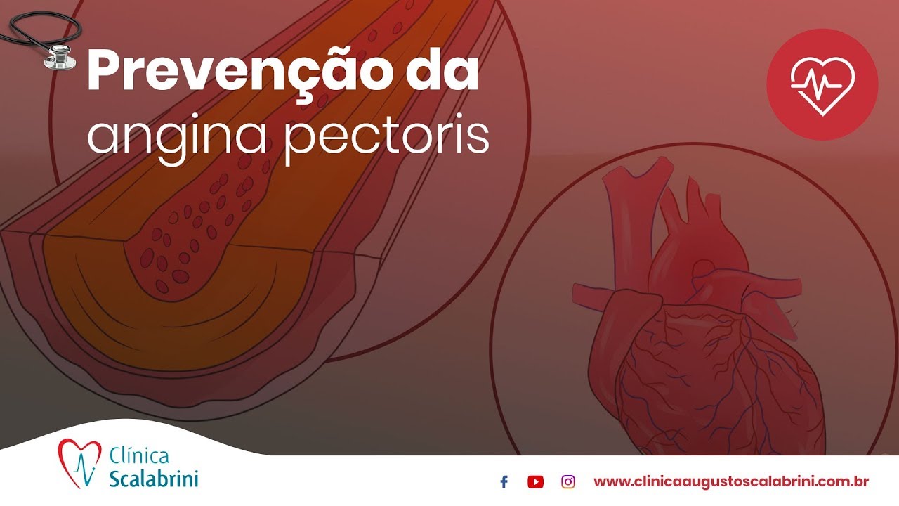 Angina pectoris: o que é e prevenção | Prof. Augusto Scalabrini