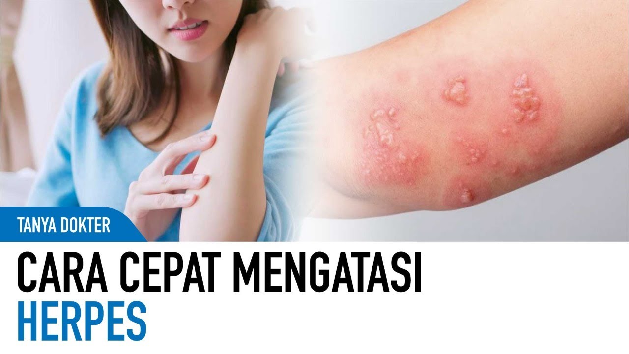 Herpes di Bibir? Ini Pertolongan Pertama Di Rumah Untuk Mempercepat Penyembuhan | Kata Dokter