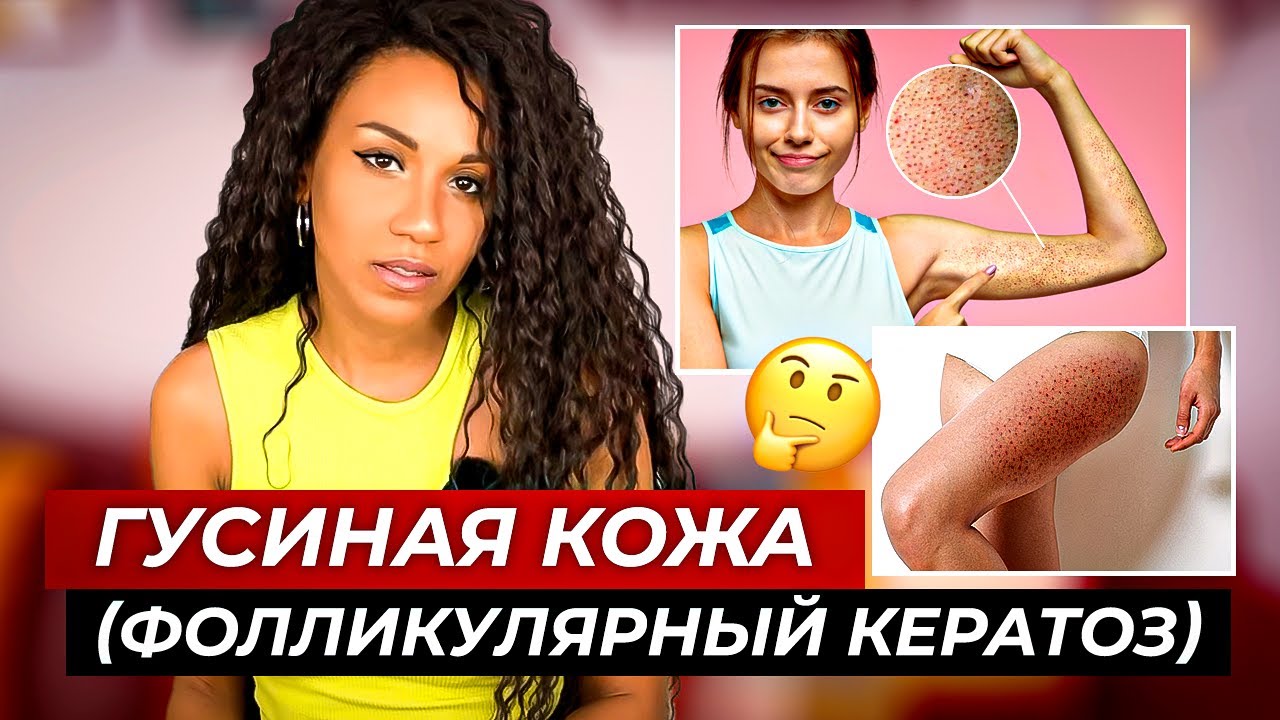 ГУСИНАЯ КОЖА // Фолликулярный кератоз: простые рекомендации  как сделать кожу гладкой