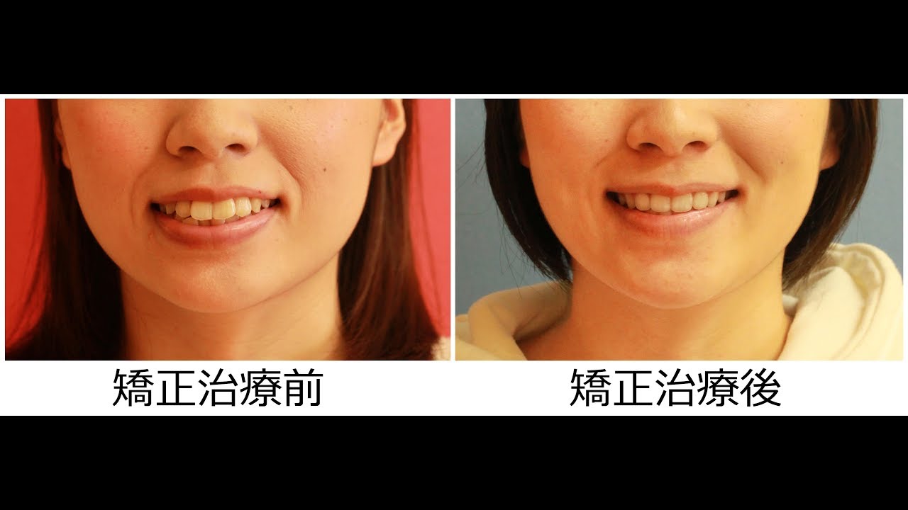 24歳 女性  「口もを 下げたい」治療期間17か月（ 上下顎前突症 ）