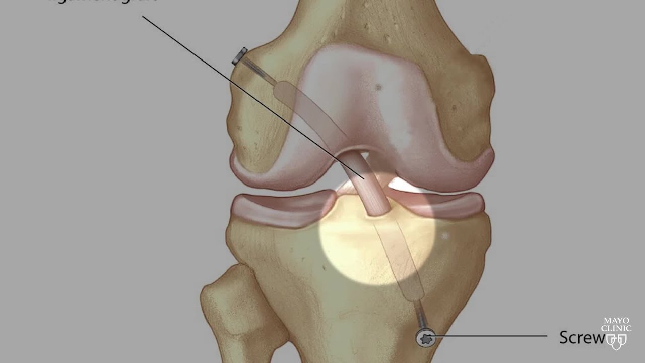 Mayo Clinic Orthopedics and Sports Medicine: ACL
