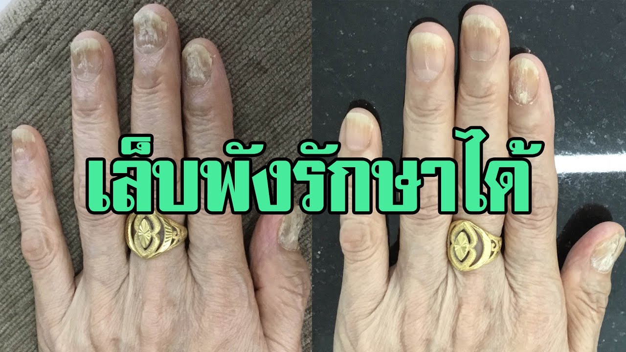 คุยกับ นพ.สมนึก อมรสิริพาณิชย์ เรื่องเล็บพังรักษาได้