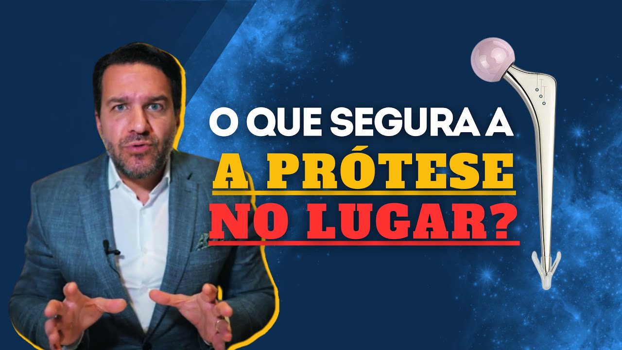 Afinal, como a prótese se fixa ao quadril? - Dr. David Gusmão