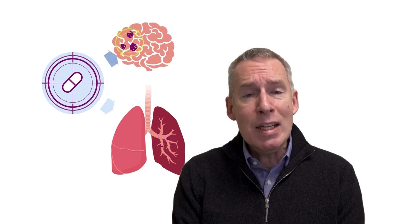 How are Lung Cancer Brain Mets Treated?
