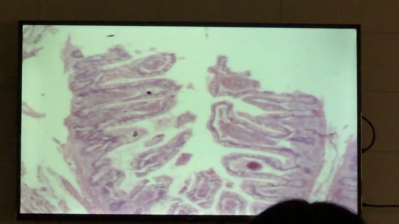 Lesión, adaptación y muerte celular. Infarto de intestino delgado