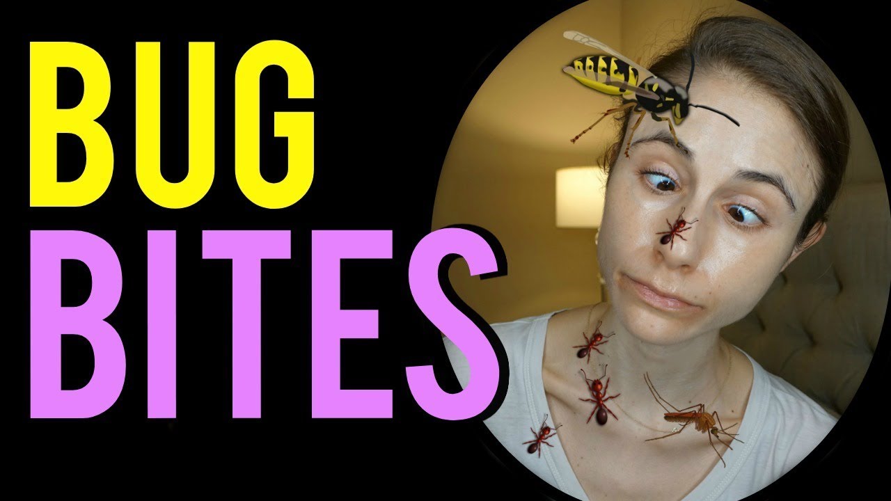 HOW TO STOP BUG BITES FROM ITCHING | Dermatologist @Dr Dray