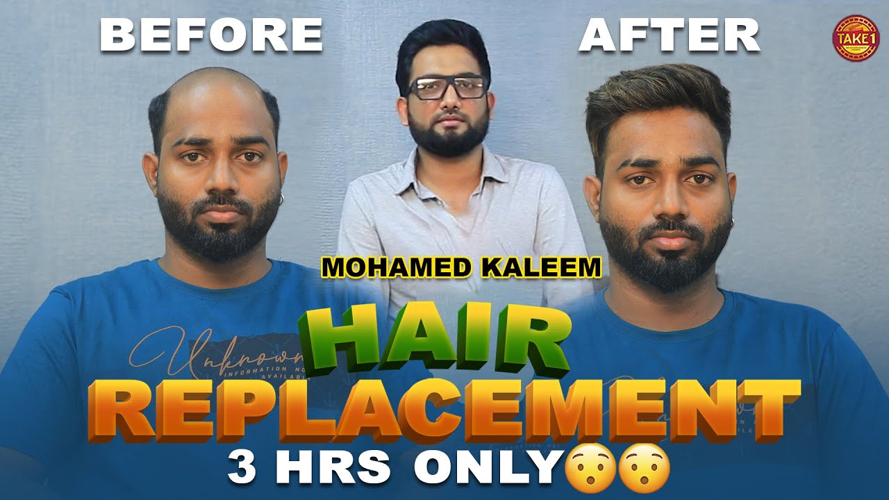 மூன்றே மணி நேரத்தில் மண்டையில் முடி! l 3 hours quick remedy l DR HAIR l Mohamed Kaleem | Take 1