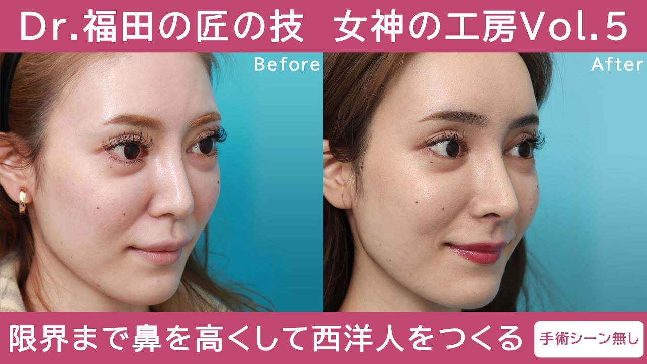 【西洋人のようになりたい】Dr.福田の女神の工房Vol.5（手術シーン無しショートバージョン）｜ヴェリテクリニック