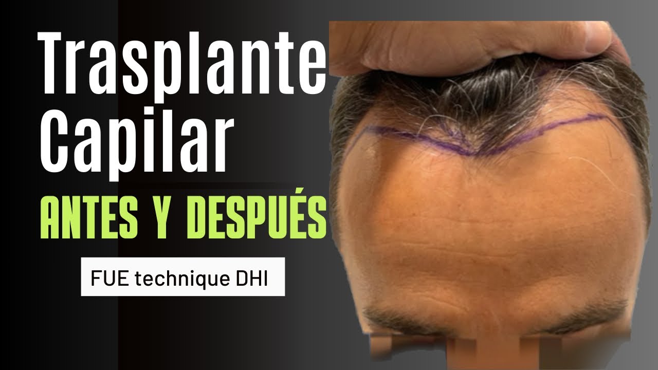 TRASPLANTE CAPILAR ANTES Y DESPUÉS RESULTADO