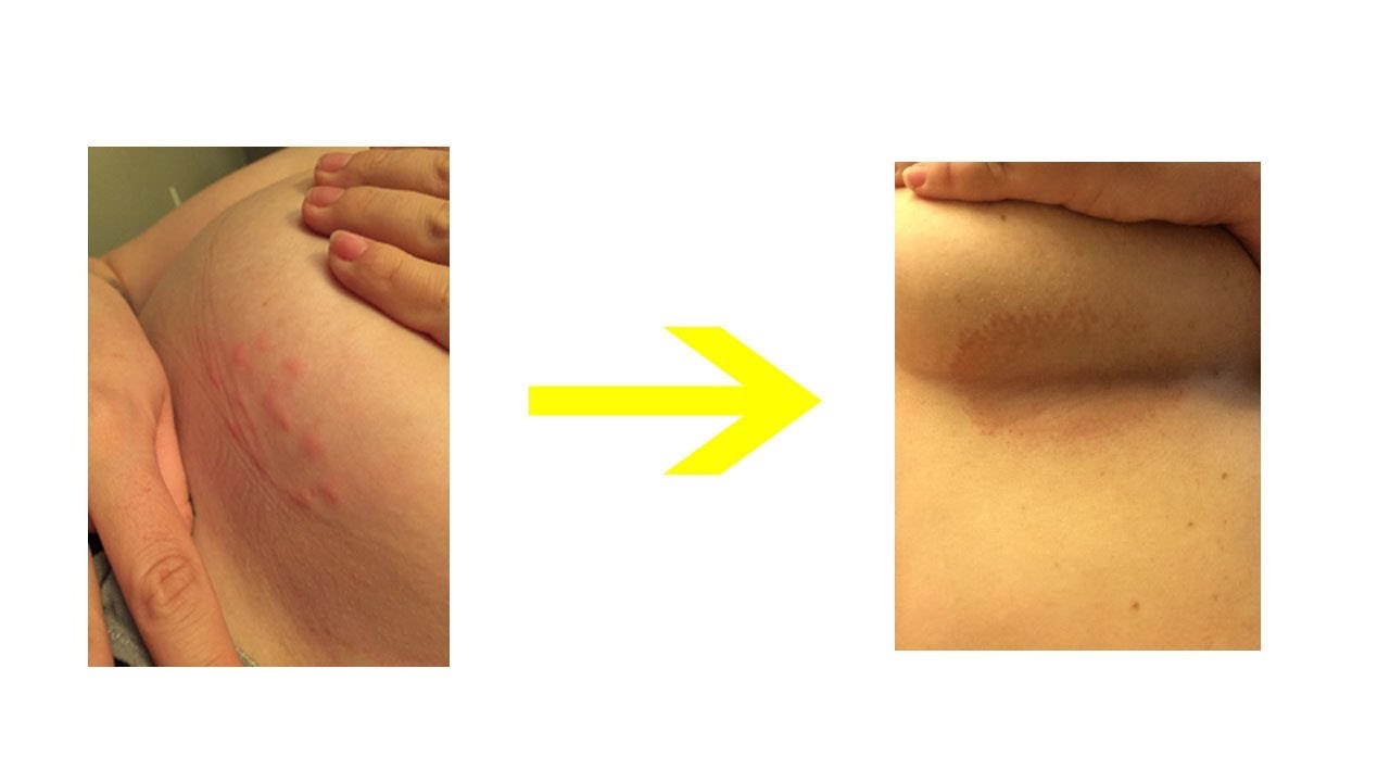 No more  Rash under Breasts After use this remedies you can see the result