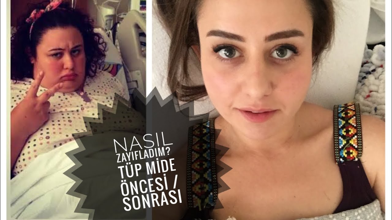 NASIL ZAYIFLADIM? #2 - TÜP MİDE AMELİYAT ÖNCESİ / SONRASI