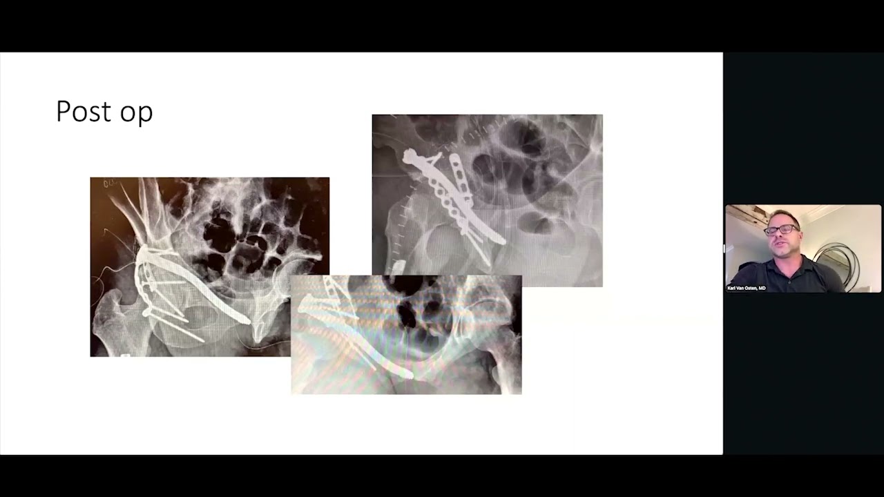 Utilizing CurvaFix in Posterior Column Fractures