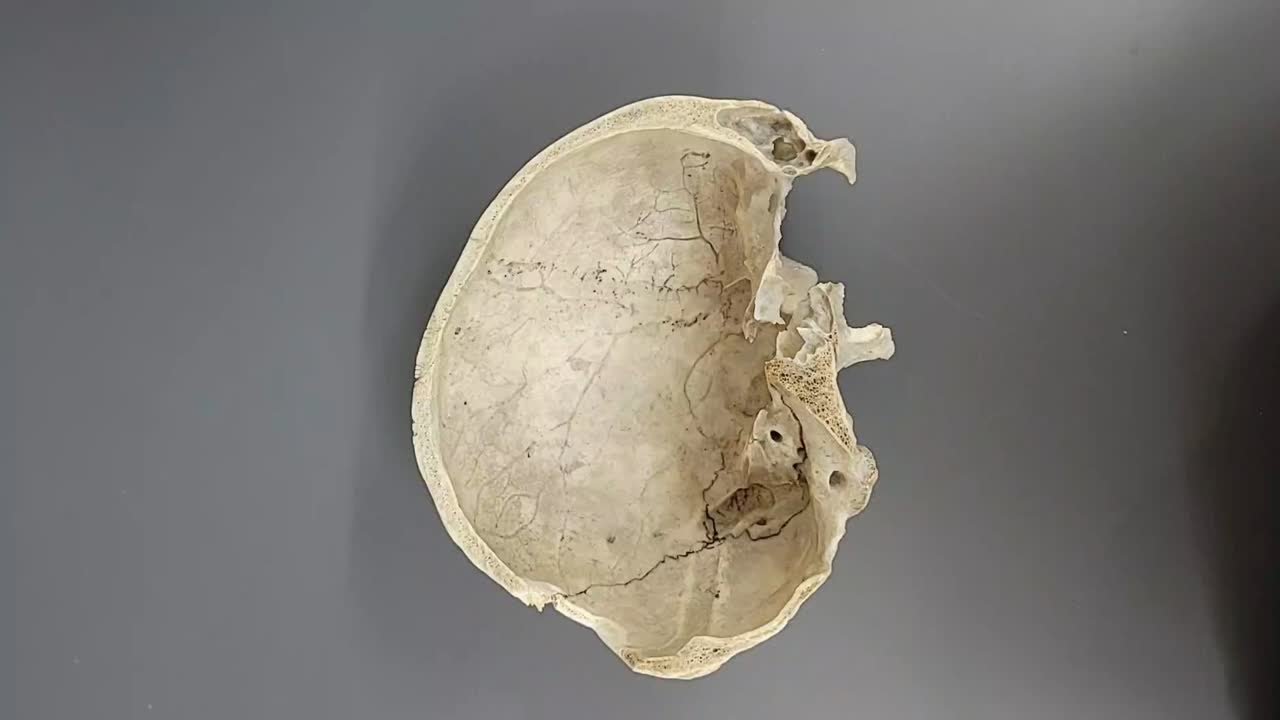 你的颅骨实际上非常的脆弱