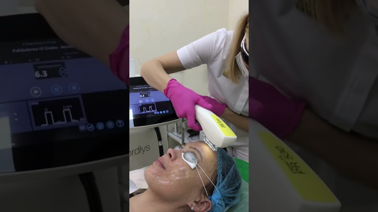 Фотоомоложение лица на аппарате Candela Nordlys в клинике косметологии Персонель Екатеринбург