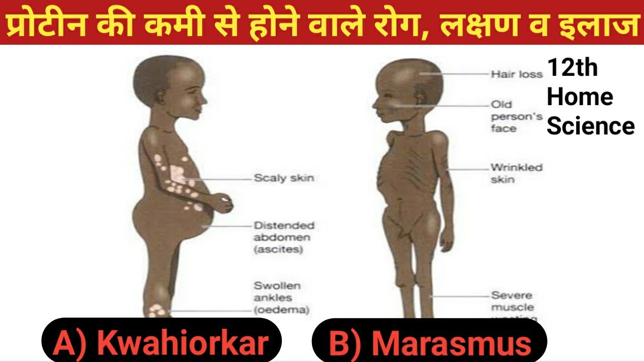 प्रोटीन की कमी से होने वाले रोग, लक्षण व इलाज || Kwashiorkor disease || Marasmus disease