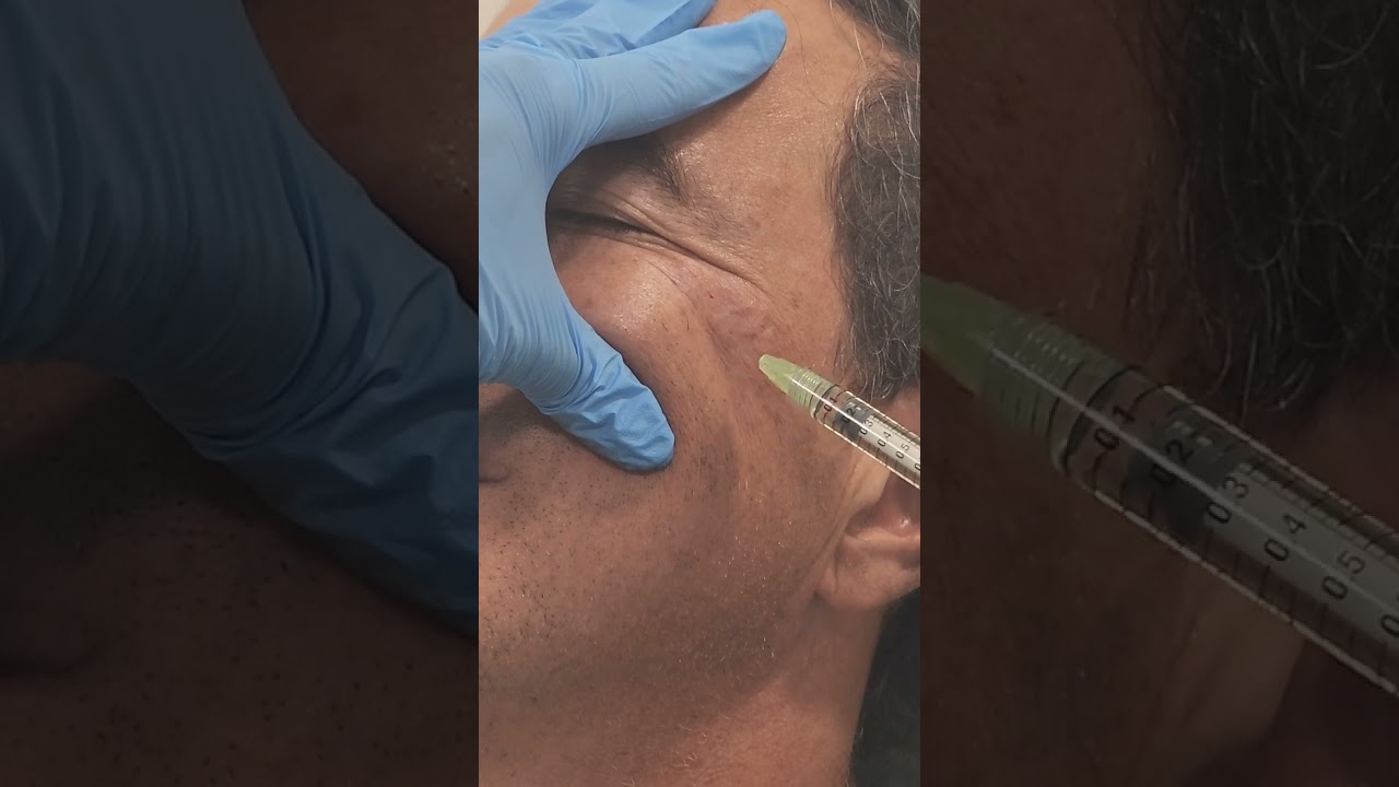 Ácido Hialurónico para arrugas (patas de gallo) - Dr. Angélica Domínguez Dermatóloga Bogotá
