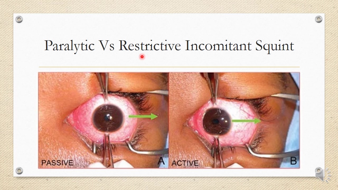 Differential diagnosis of Incomitant Squint