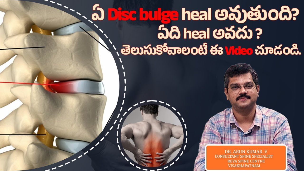 ❓Which Disc Bulge is Cured? Which Disc Bulge is Not Cured? | Expert Insights By Dr. Arun Kumar V