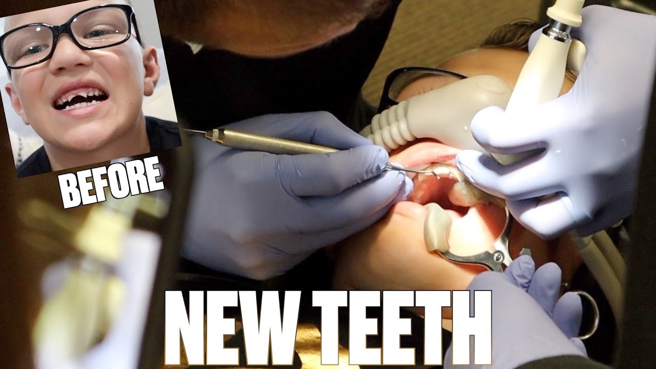 HAVING NEW TEETH PUT IN AFTER GETTING BOTH FRONT TEETH KNOCKED OUT!