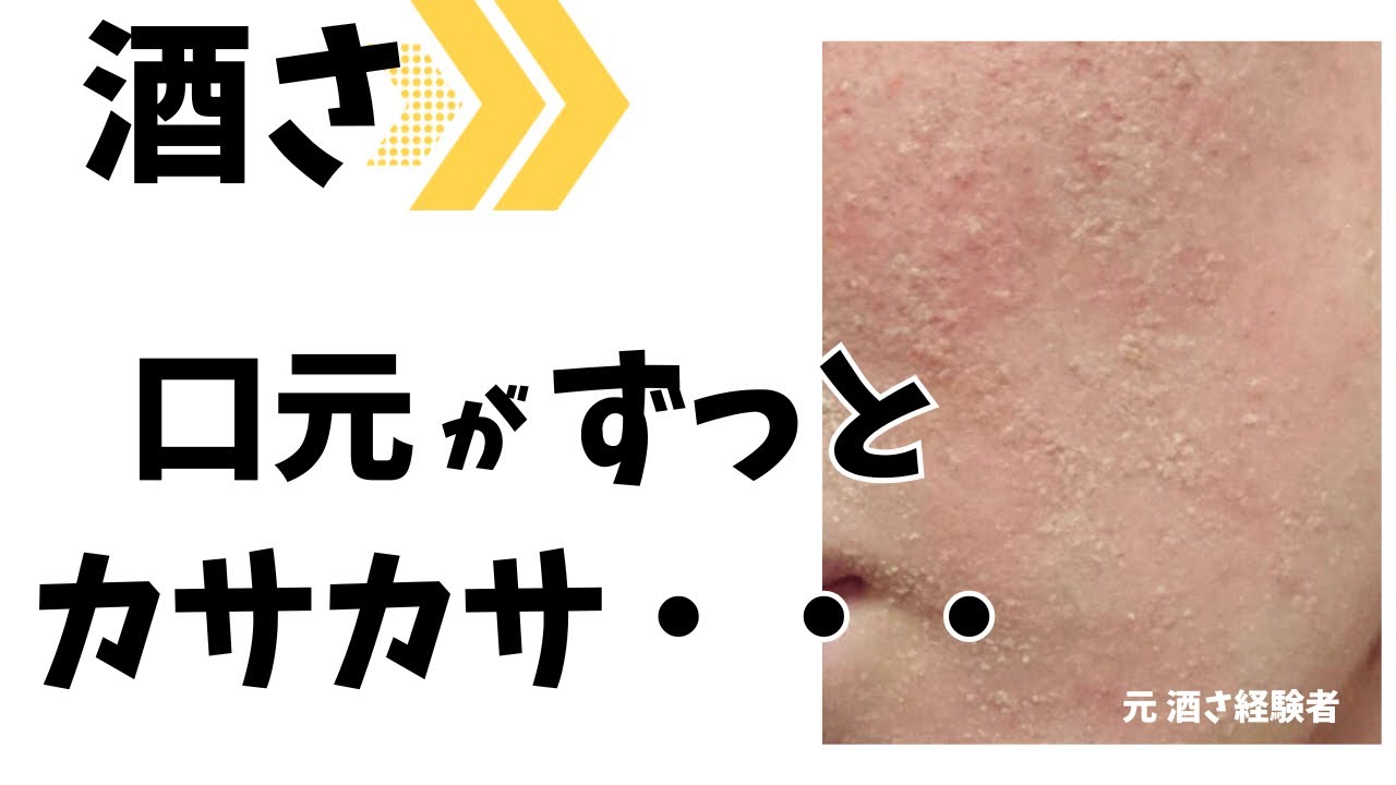 【酒さ】口元のカサカサがずっと続く原因