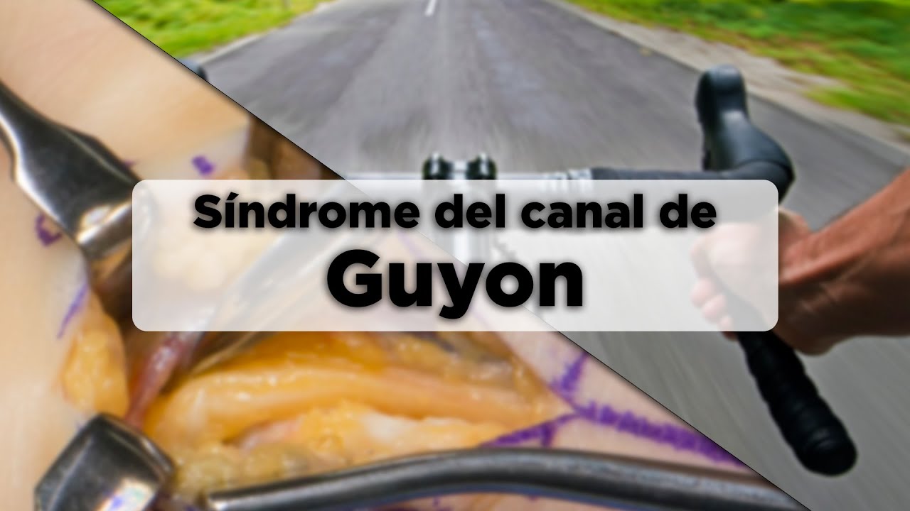 Síndrome del túnel ulnar (Canal de Guyon)
