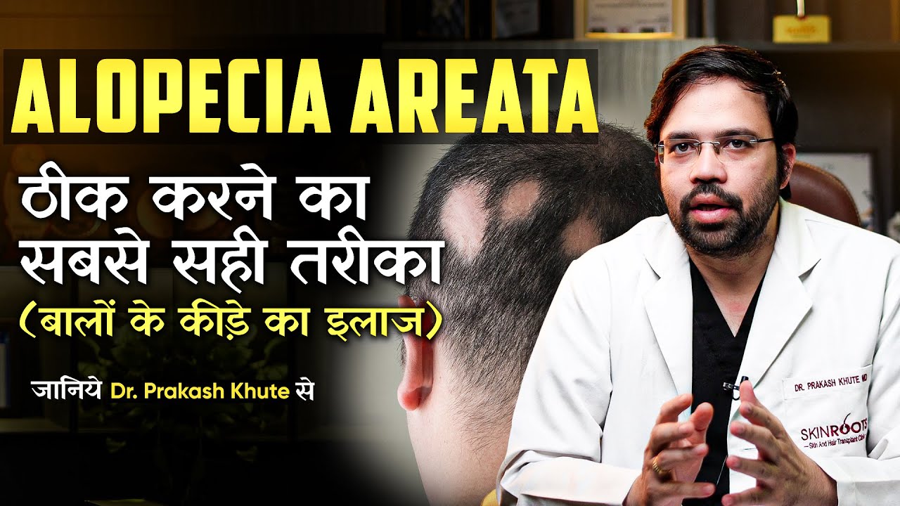 Alopecia Areata | बालों के कीड़े का इलाज – Causes, Symptoms & Best Treatments for Patchy Hair Loss