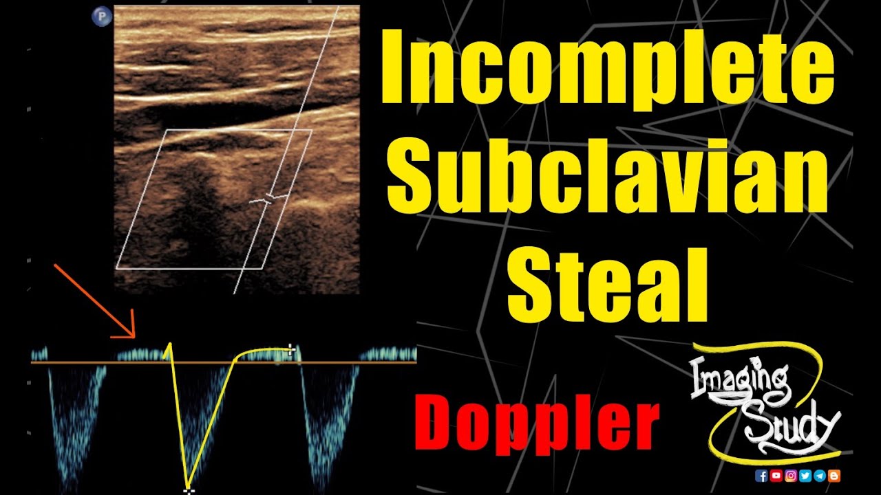 Incomplete Subclavian Steal || Ultrasound || Doppler || Case 241