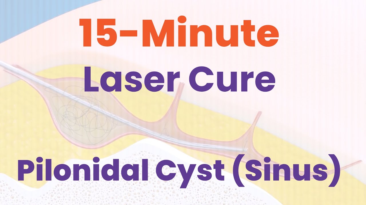 15-Minute Laser Treatment for Pilonidal Cyst (Sinus) – Minimal Pain, Fast Recovery