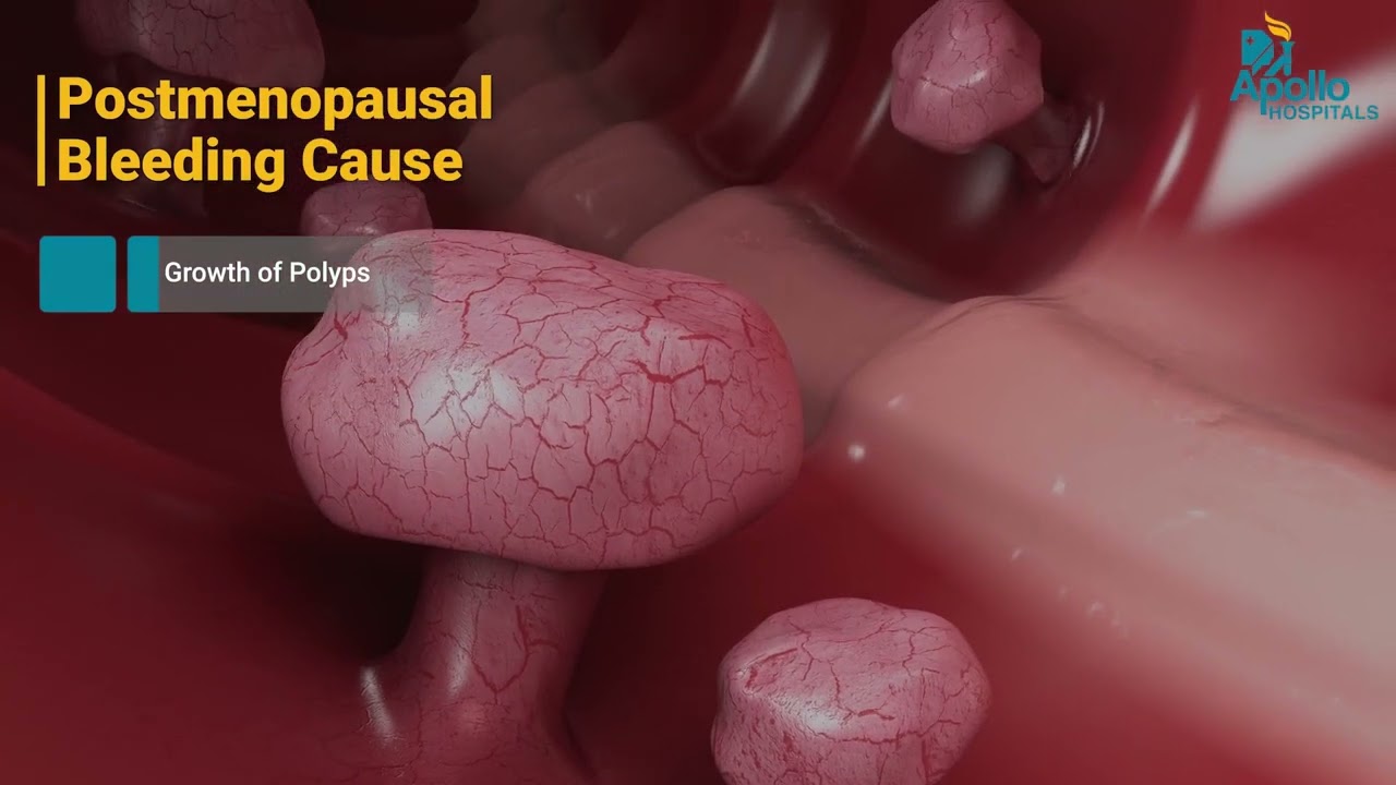 نزيف ما بعد انقطاع الطمث: متى يجب الفحص وخيارات العلاج | Dr. Revathi | Apollo Secunderabad