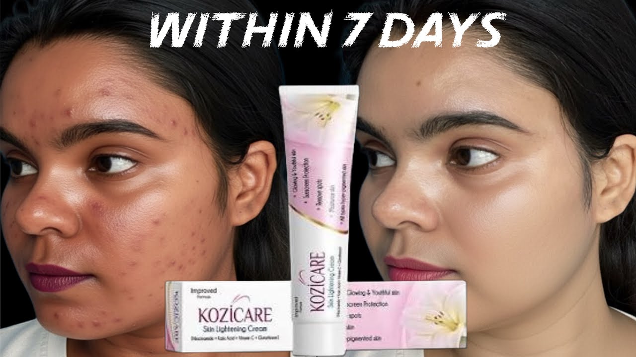 Kozicare Skin Whitening Cream Review | Pigmentation, Dark Spots, Tan Removal सच या झूठ? |