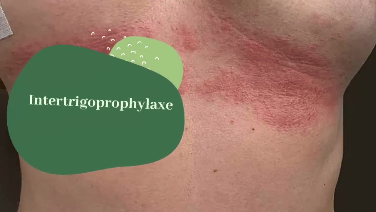 Intertrigoprophylaxe einfache Erklärung